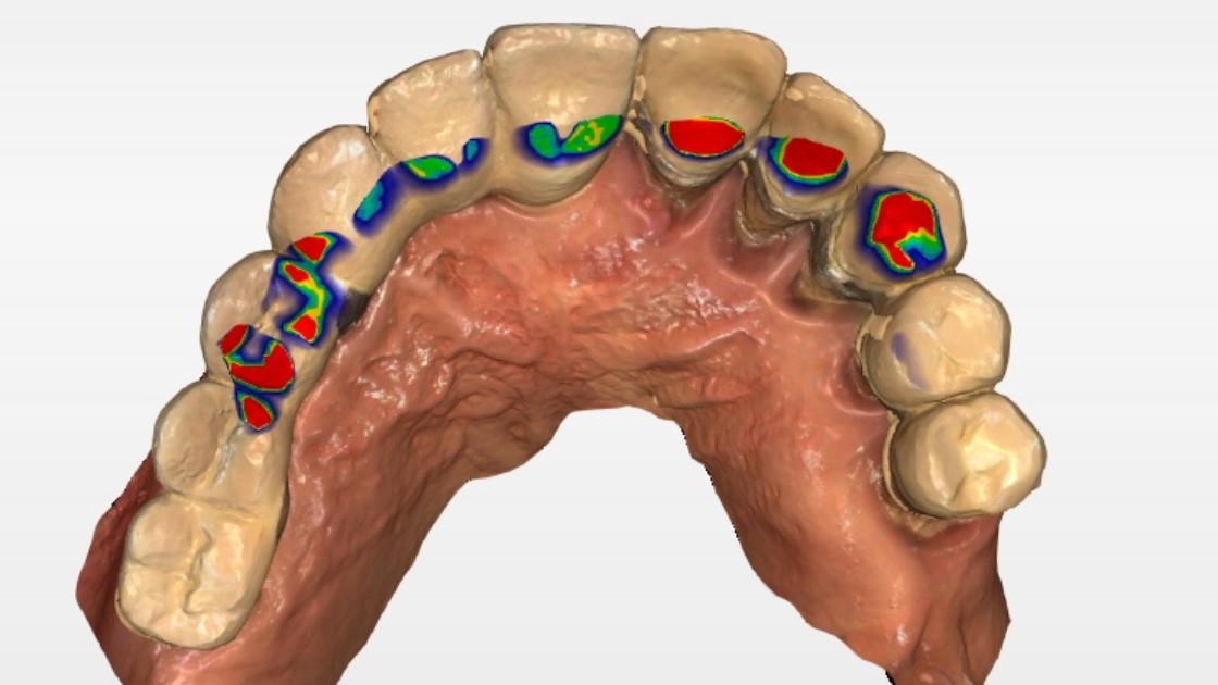 Mal di testa e occlusione dentale
