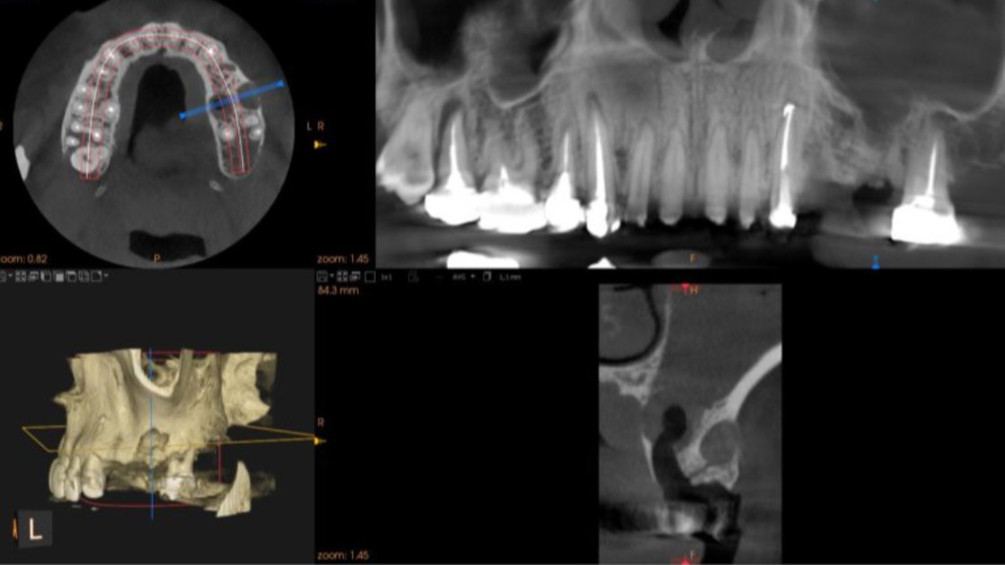 Utilizzo delle cellule staminali in odontoiatria