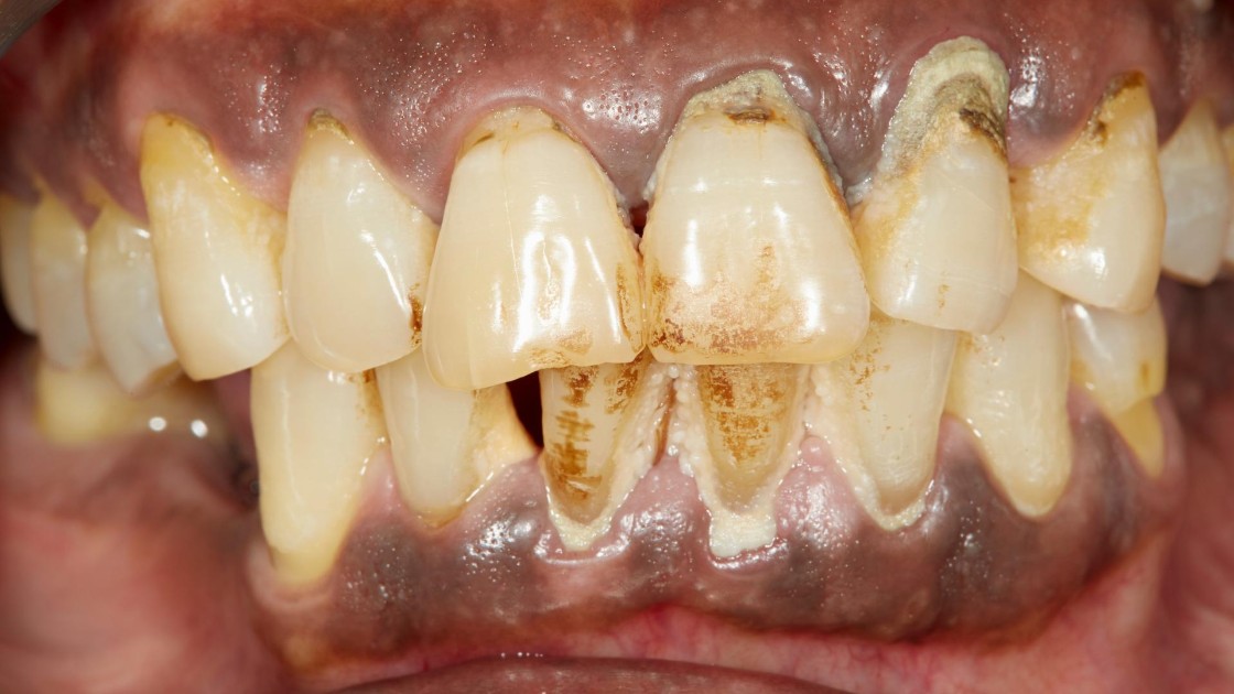 La parodontite: approfondimenti