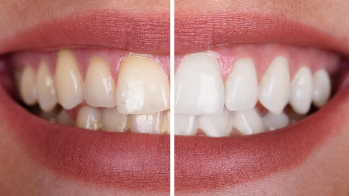 Lo sbiancamento dentale