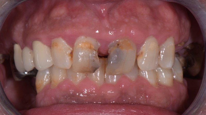 Recupero protesico e funzionale di paziente fobico