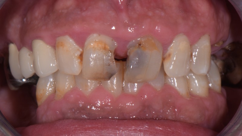 Prima del trattamento