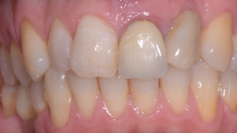 Prima del trattamento