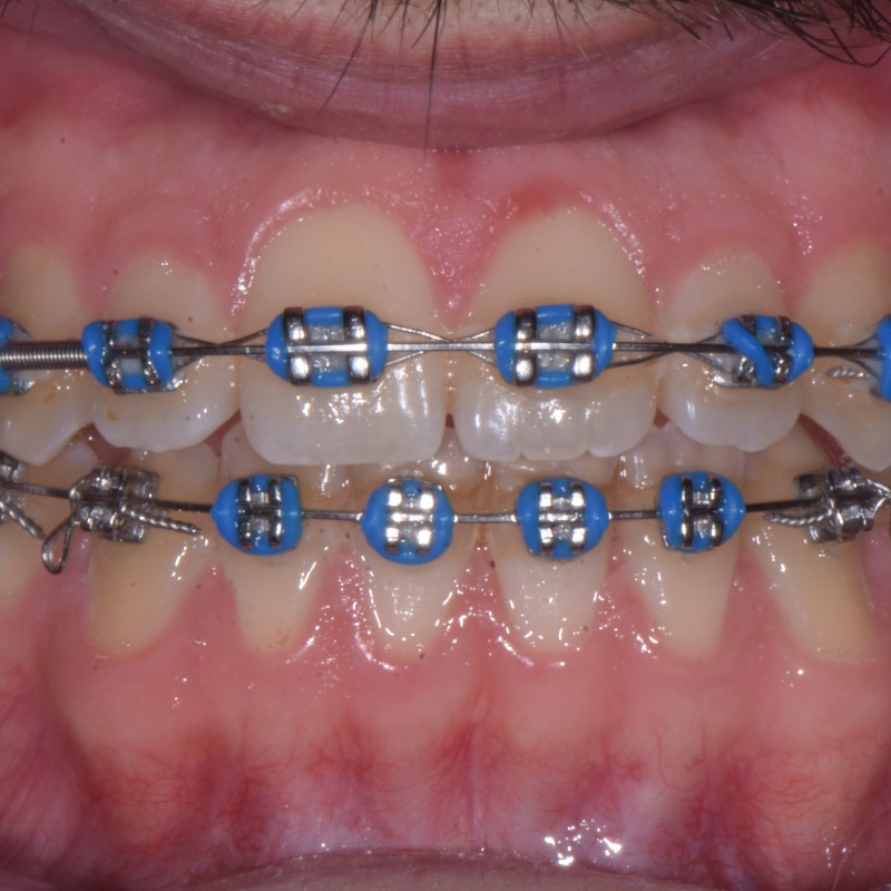 Allineamento dentale senza chirurgia di un paziente potenziale chirurgico