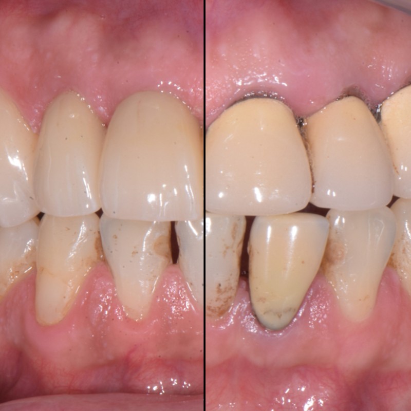 Rifacimento corone non congrue