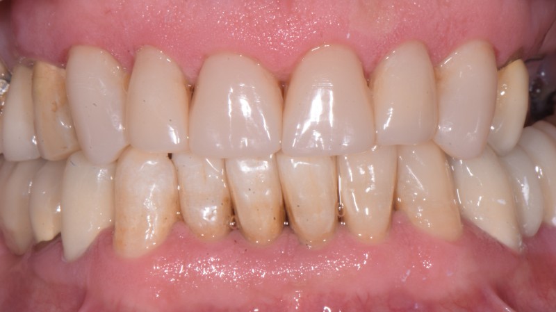 Faccette dirette con tecnica Flow Injection