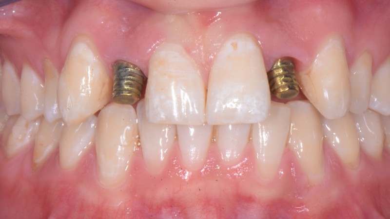 Utilizzo della protesi conometrica nella gestione dell'agenesia dei laterali